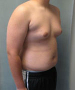 Severe Gynecomastia