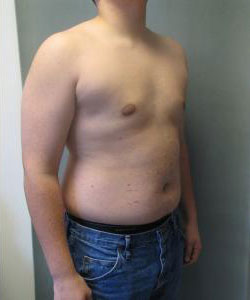 Severe Gynecomastia