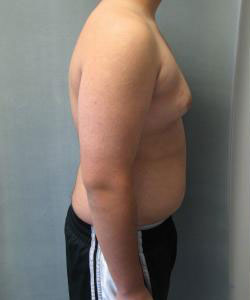 Severe Gynecomastia