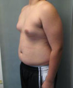 Severe Gynecomastia