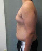 Severe Gynecomastia