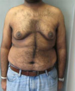 Severe Gynecomastia