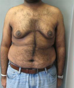 Severe Gynecomastia Before Photo Severe Gynecomastia
