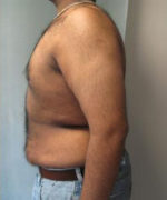 Severe Gynecomastia