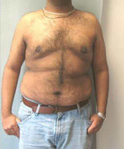 Severe Gynecomastia