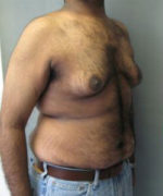 Severe Gynecomastia