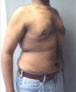 Severe Gynecomastia