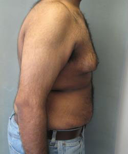 Severe Gynecomastia