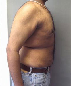 Severe Gynecomastia