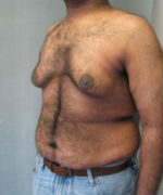 Severe Gynecomastia