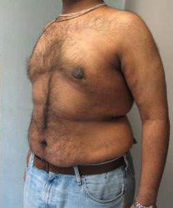 Severe Gynecomastia