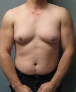 Severe Gynecomastia