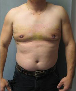 Severe Gynecomastia After Photo Severe Gynecomastia