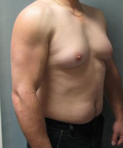 Severe Gynecomastia