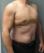 Severe Gynecomastia