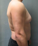 Severe Gynecomastia