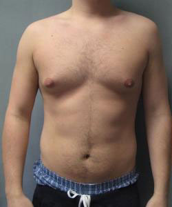 Severe Gynecomastia Before Photo Severe Gynecomastia