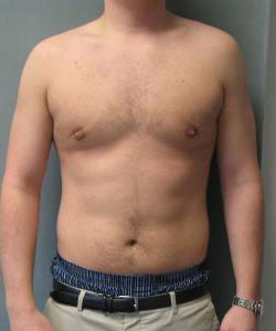 Severe Gynecomastia After Photo Severe Gynecomastia