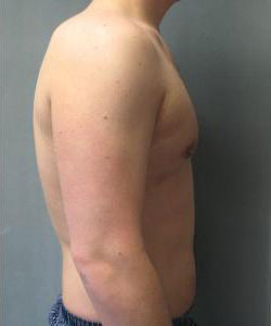 Severe Gynecomastia