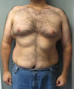 Severe Gynecomastia Before Photo Severe Gynecomastia
