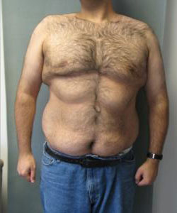 Severe Gynecomastia