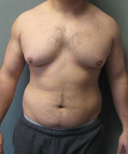 Severe Gynecomastia Before Photo Severe Gynecomastia