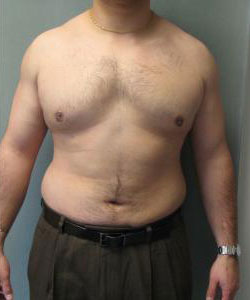 Severe Gynecomastia After Photo Severe Gynecomastia