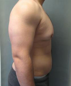 Severe Gynecomastia