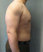 Severe Gynecomastia