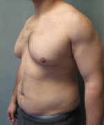 Severe Gynecomastia