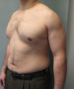 Severe Gynecomastia