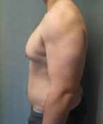 Severe Gynecomastia