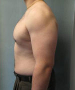 Severe Gynecomastia