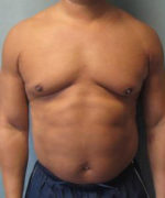 Severe Gynecomastia