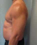 Severe Gynecomastia