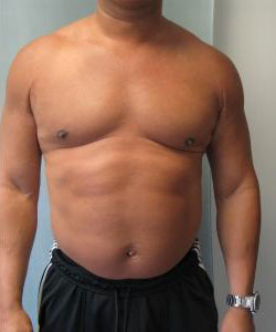 Severe Gynecomastia