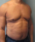 Severe Gynecomastia