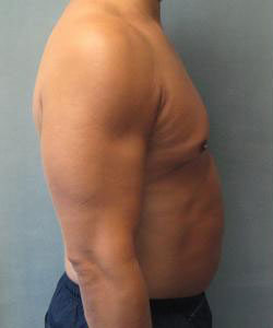 Severe Gynecomastia