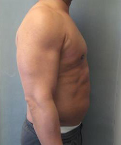 Severe Gynecomastia