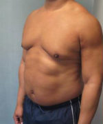 Severe Gynecomastia