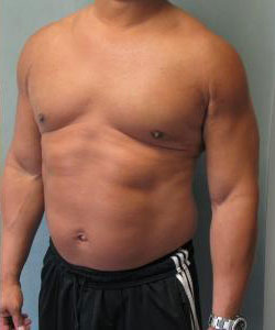 Severe Gynecomastia