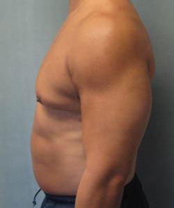 Severe Gynecomastia