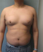 Severe Gynecomastia