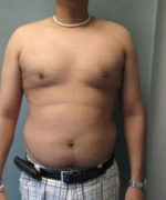 Severe Gynecomastia