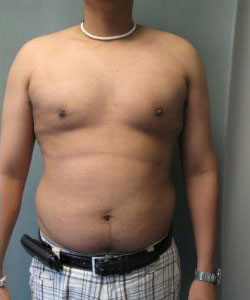 Severe Gynecomastia After Photo Severe Gynecomastia