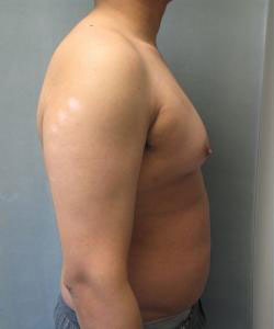 Severe Gynecomastia