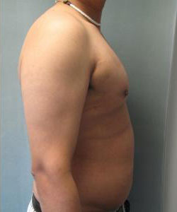 Severe Gynecomastia