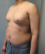 Severe Gynecomastia