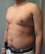 Severe Gynecomastia