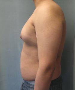 Severe Gynecomastia